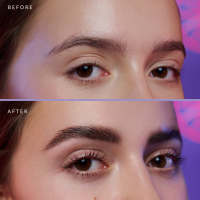 Korean Brow Lifting